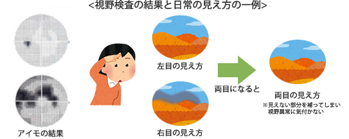 視野検査の結果と日常の見え方の一例