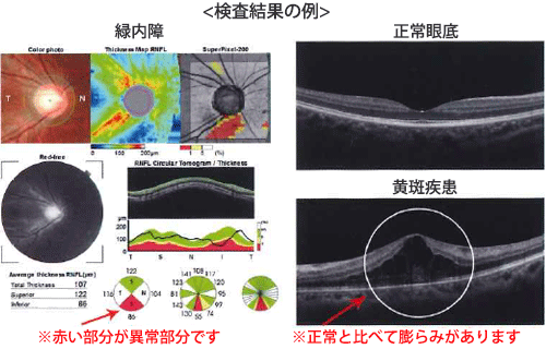 視野検査の結果と日常の見え方の一例